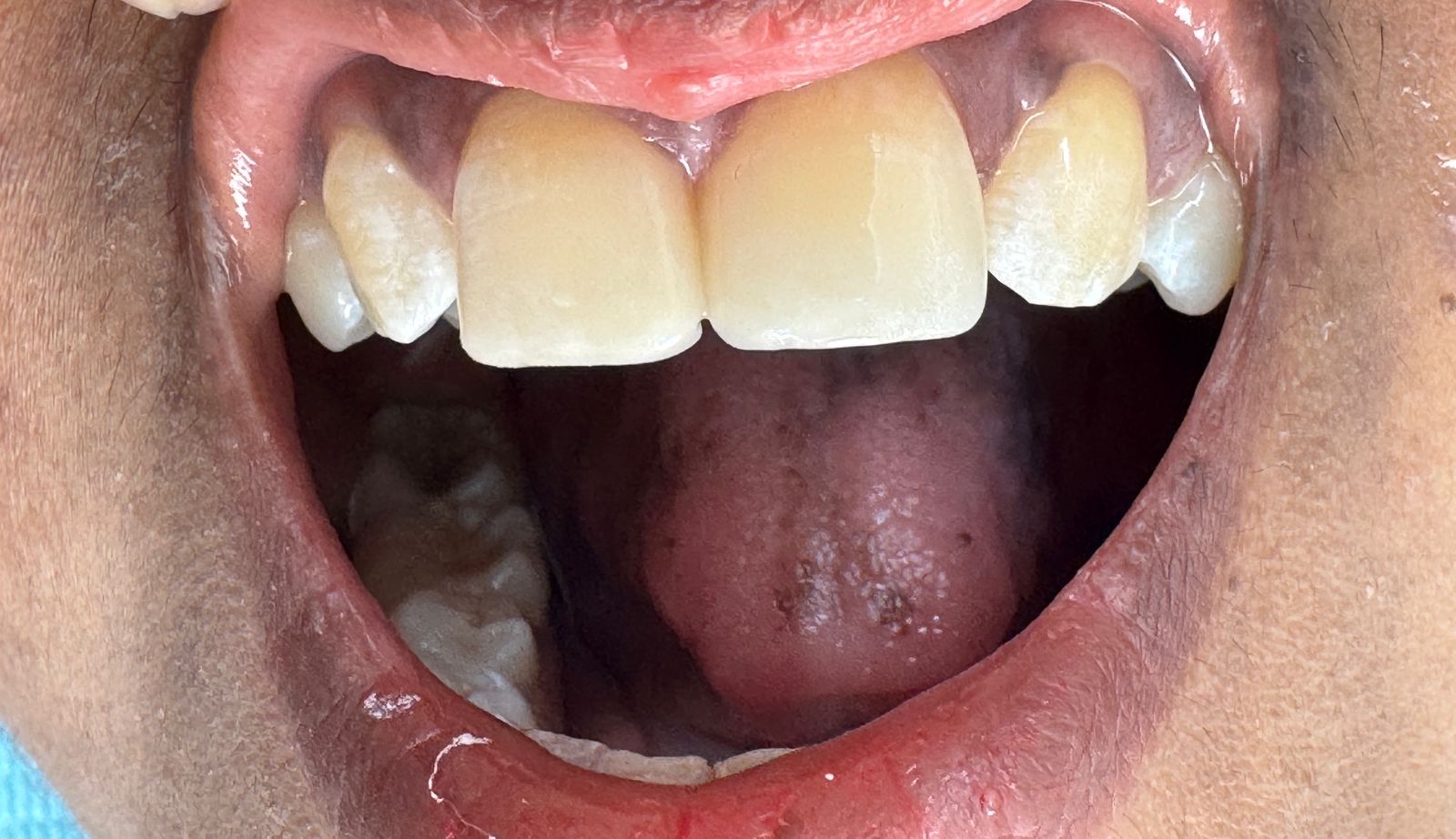 Aesthetic Space Closure after treatment